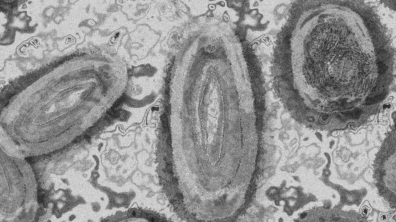 Viruela del mono: dos nuevos casos detectados en Medellín Viruela del mono