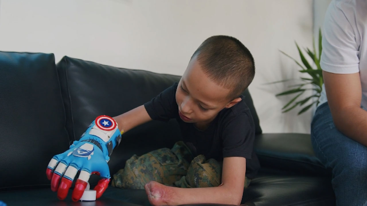 Samuel recibió prótesis elaborada en impresión 3D prótesis