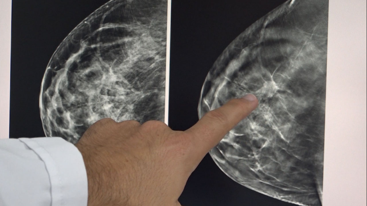 Cáncer de mama: 15.000 casos anuales en Colombia 2 cáncer