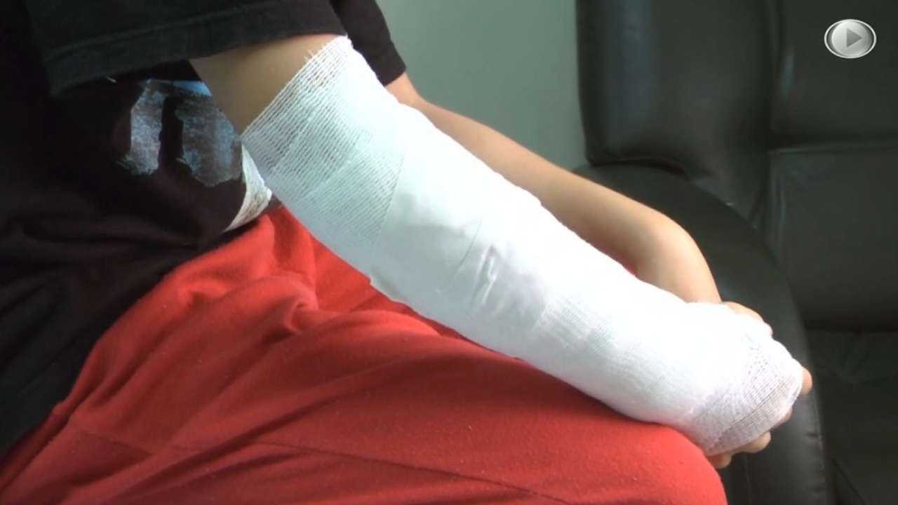 Se registran 19 casos de quemados por pólvora en Antioquia lesionados-polvora