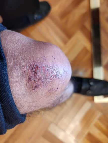 Presidente Petro explicó su ausencia: sufrió una caída y compartió una foto de su rodilla herida 1 1 1
