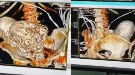 feto calcificado-mujer-infeccion