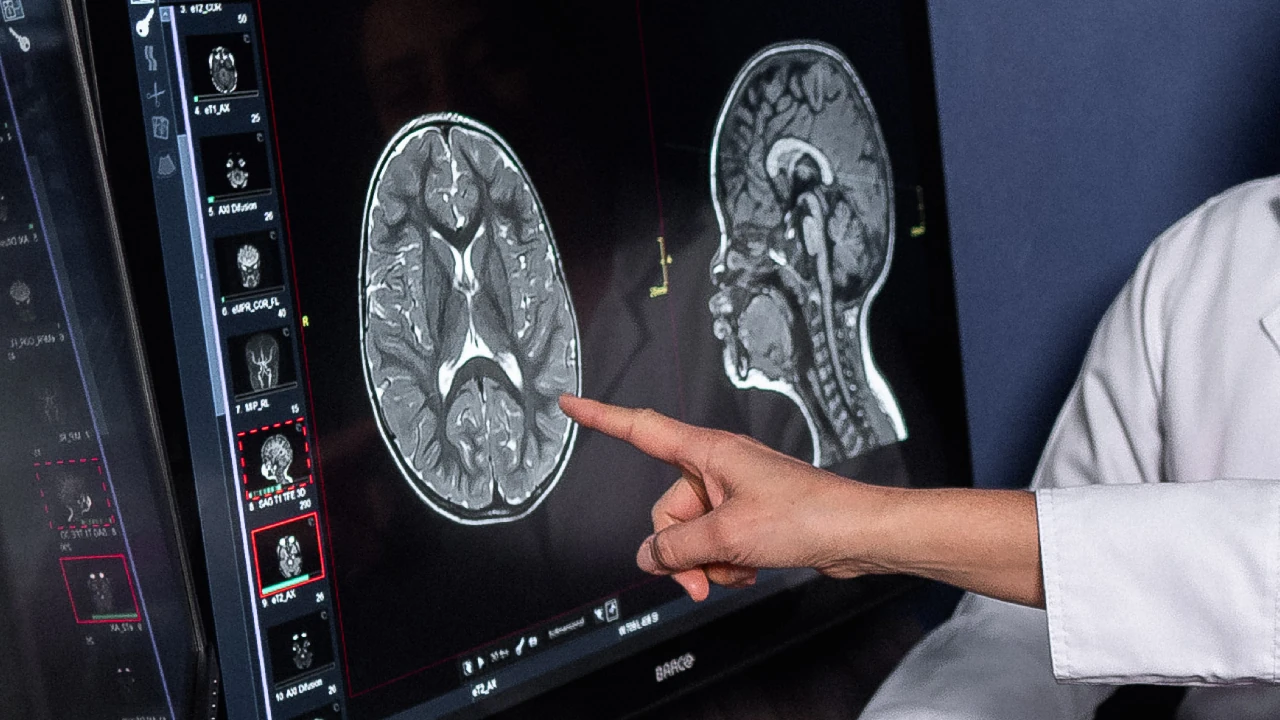 En Colombia el 60 de los pacientes con meningitis son ninos