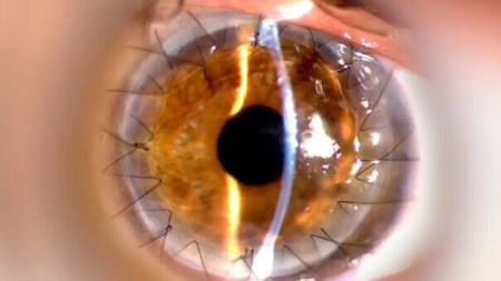 En Medellín, el primer Banco de Ojos fomenta la donación de córneas En Medellín, el primer Banco de Ojos fomenta la donación de córneas