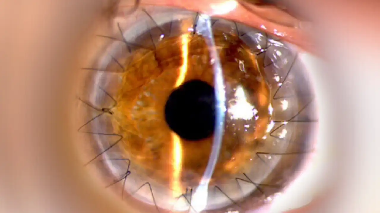 En Medellín, el primer Banco de Ojos fomenta la donación de córneas