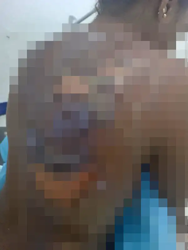 En Turbo, Antioquia, una joven fue quemada con agua caliente, al parecer, por una tía 