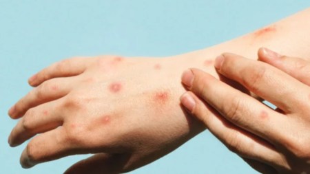 viruela-del-mono-oms