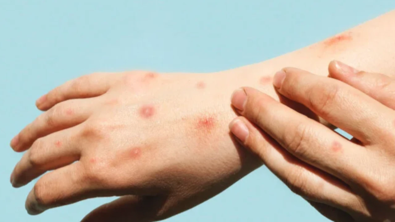 viruela-del-mono-oms