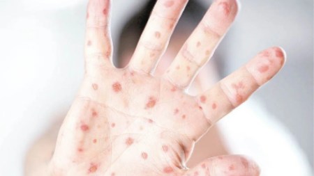 viruela del mono en Colombia