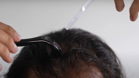 ¿Qué hacer? En Colombia cerca de 2.6 millones de hombres podrían padecer alopecia alopecia