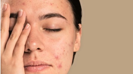¡Cuíde su piel! Una de cada cinco personas en el mundo se ve afectada por el acné