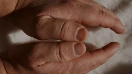 Colombia enfrenta el desafío de 6.000 enfermedades huérfanas: la Acromegalia que afecta a 200 personas anualmente