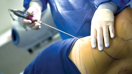 Al descubierto el modus operandi de la estructura que habría sometido a 55 mujeres a procedimientos estéticas ilegales en espacios improvisados