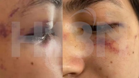 Denuncia: adolescente quedó hospitalizada tras brutal golpiza a manos de su propia madre en Robledo