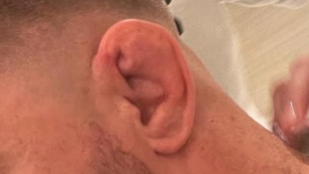 La oreja de coliflor, la marca de los deportistas de combate