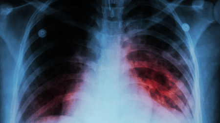 Antioquia, pionero en implementar las PCR como prueba para el diagnóstico de tuberculosis