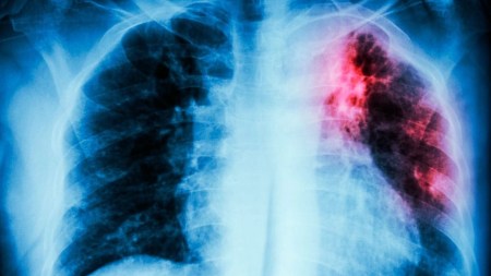 tuberculosis-salud-pulmones