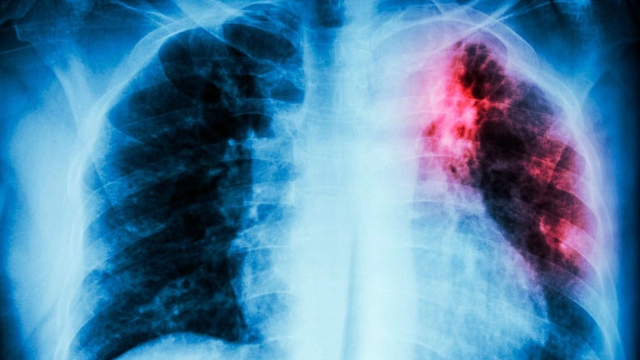 Con 967 casos reportados de Tuberculosis en Antioquia se encienden las alertas: ¿Cómo combatirla? tuberculosis-salud-pulmones
