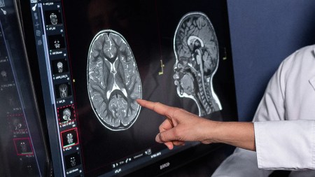 Hoy se conmemora el Día Internacional de los Tumores Cerebrales Hoy se conmemora el Día Internacional de los Tumores Cerebrales