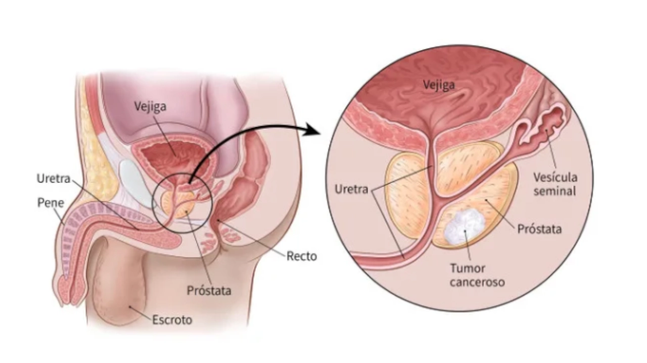 ¡Para recordar! El 11 de junio se conmemora el día mundial de la prevención del cáncer de próstata 1 prostata