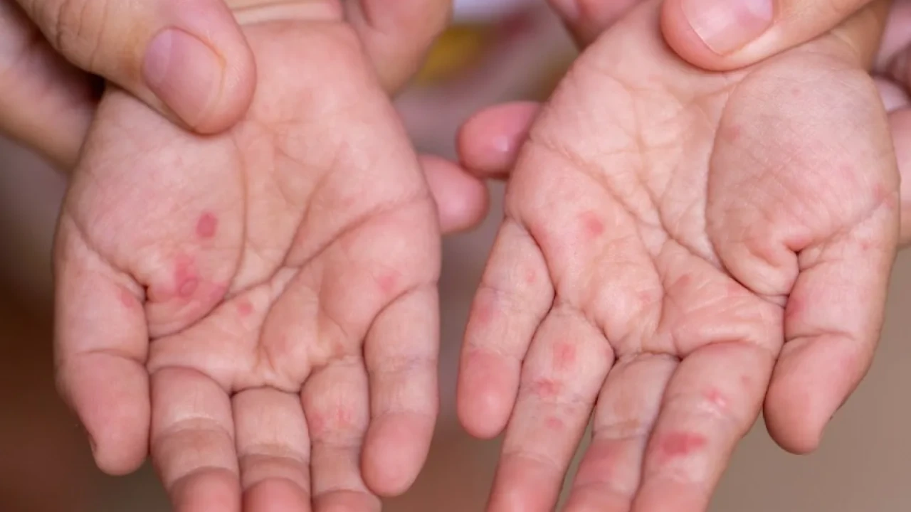 INS lanza alerta por aumento de casos del virus de manos, pies y boca en Colombia INS lanza alerta por aumento de casos del virus de manos, pies y boca en Colombia