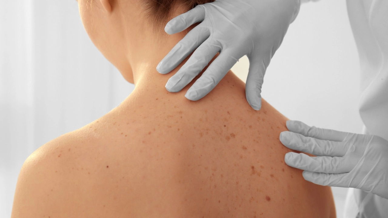 melanoma-2