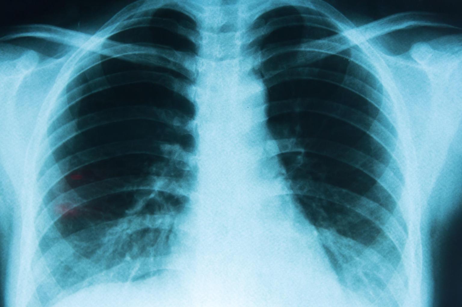 Día Mundial contra el Cáncer: avances médicos y detección temprana transforman el panorama del cáncer de pulmón lung cancer sharing