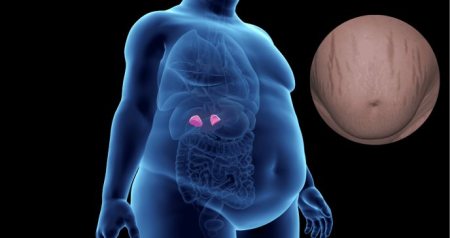 Síndrome de Cushing: una enfermedad silenciosa que impacta el corazón y el metabolismo sacs 20 85 9579fab0 focus 0 0 688 364