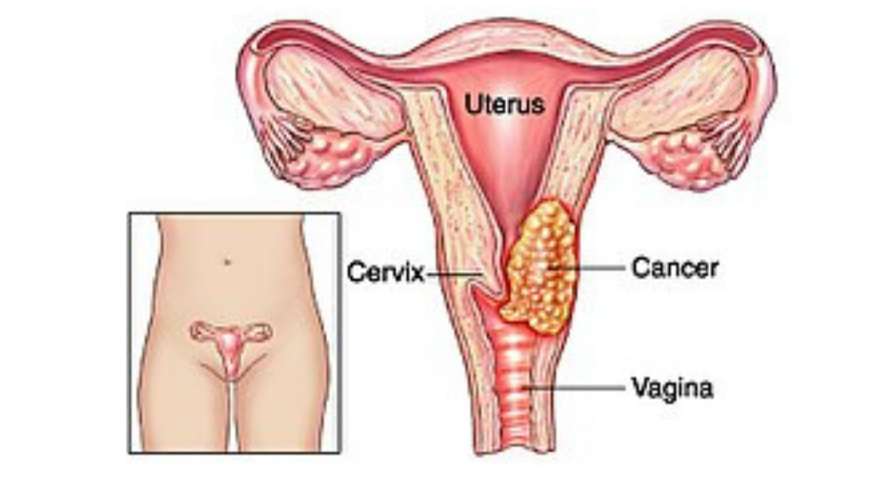 Colombia sigue llegando tarde al cáncer de cuello uterino: alertan por fallas en prevención y atención Diseno pagina Lau 2